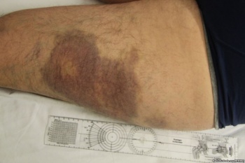 Появились фотографии ужасных ран Булатова после пыток
